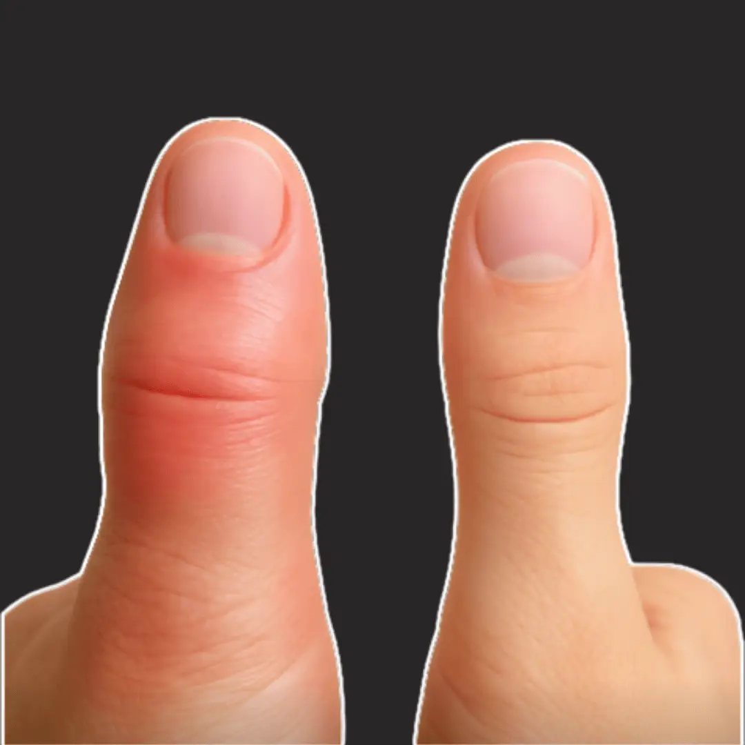 Close-up comparison of a swollen thumb and a normal thumb side by side